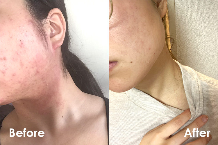 フェイスラインのBefore&After写真